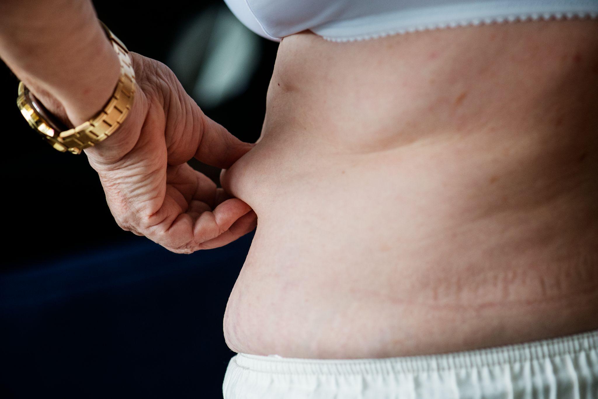 diagonse obesity image 2